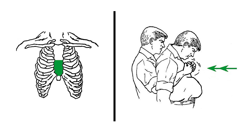Fayl:Chest thrusts against choking.jpg