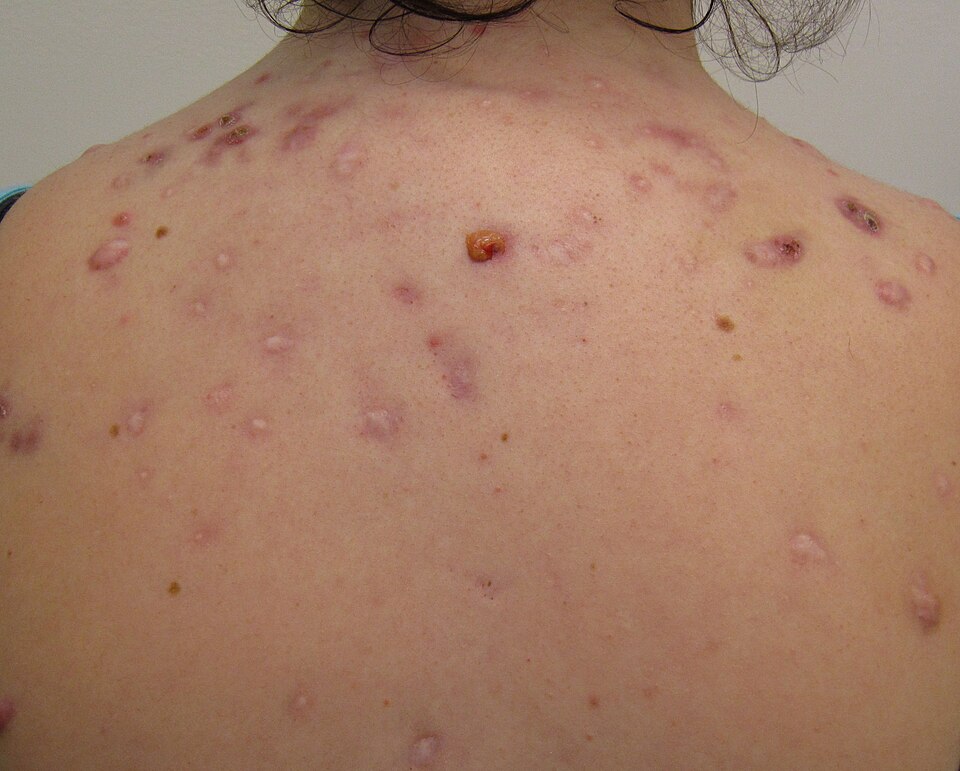 Fayl:Backacne.JPG