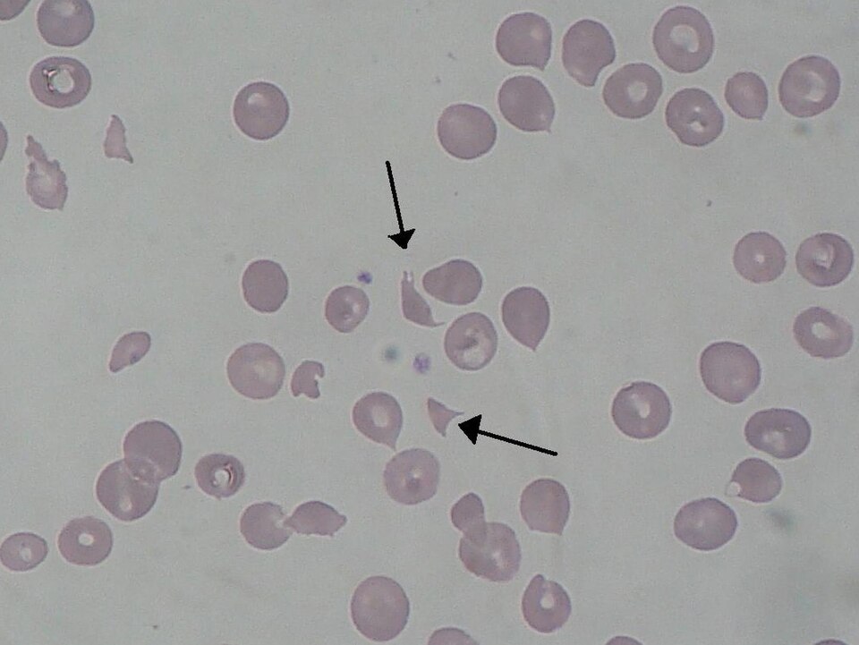 Fayl:Schizocyte smear 2009-12-22.JPG