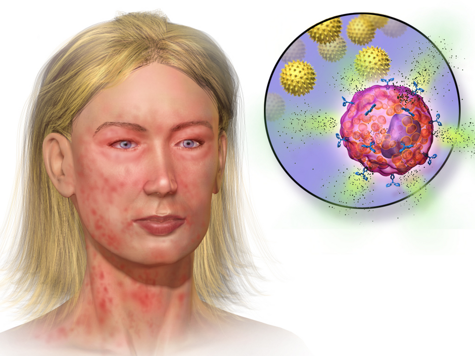 Fayl:Blausen 0018 Anaphylaxis.png