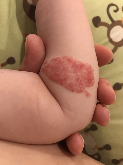 Fayl:Infantile hemangioma.jpg