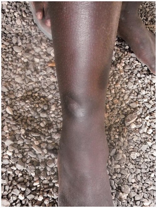 Fayl:10.1177 0956462414549036-fig8-Primary yaws, healed Lesion.jpg