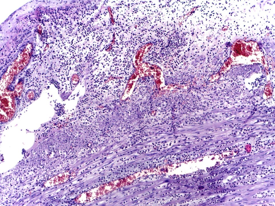 Fayl:Acute appendicitis High Power.jpg