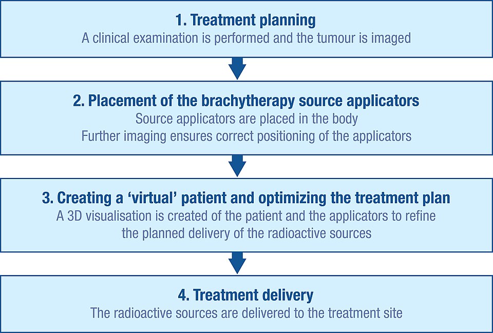 Fayl:Brachytherapy procedure flow.jpg