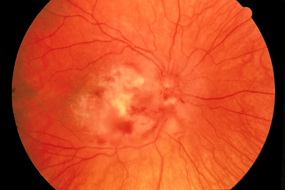 Fayl:Fundus photograph-CMV retinitis EDA07.JPG