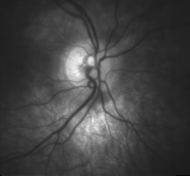 Fayl:Optic disc detail.png