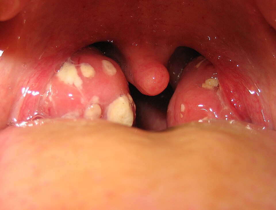 Fayl:Tonsillitis.jpg