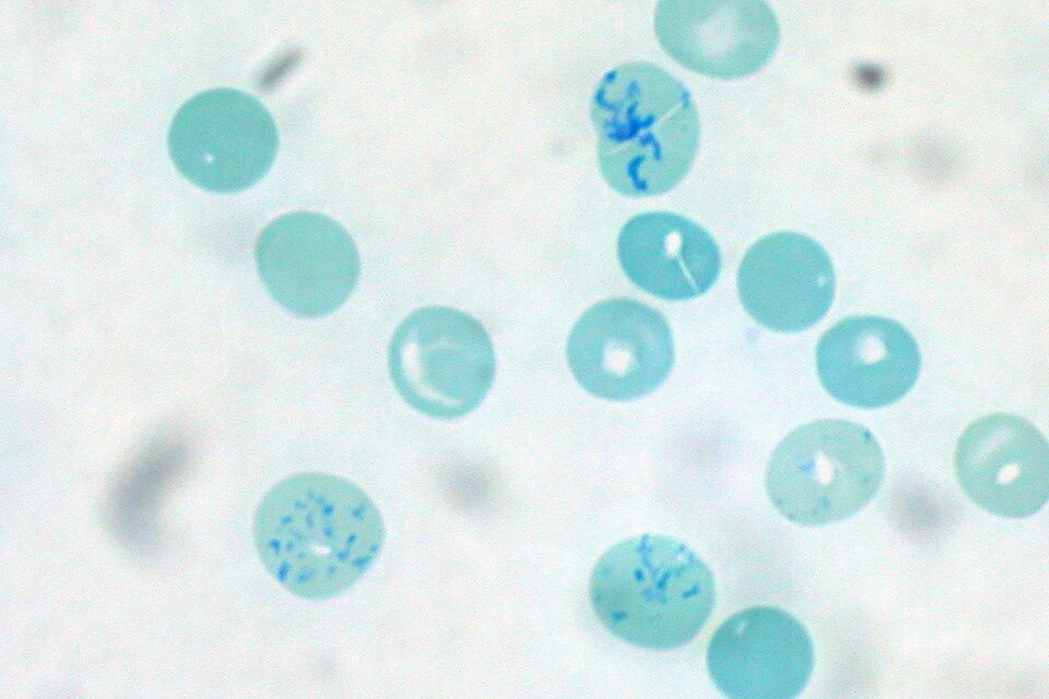 Fayl:Reticulocytes Human Blood Supravital Stain.jpg