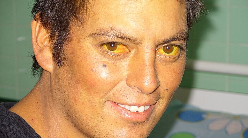 Fayl:Scleral Icterus.jpg