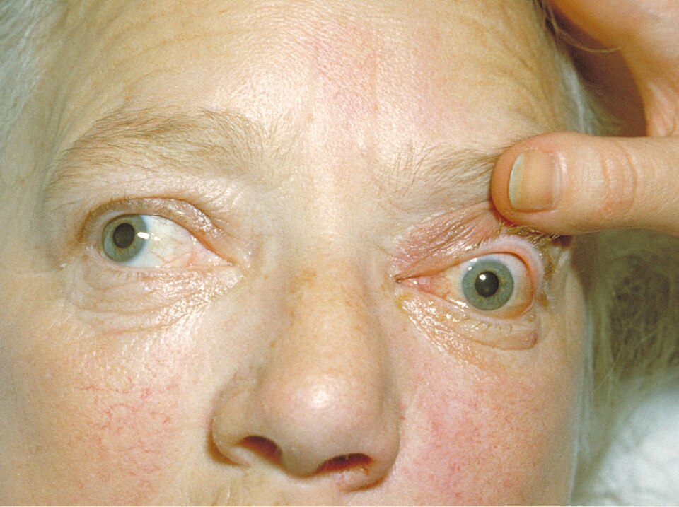 Fayl:Bilateral exophthalmos.jpg