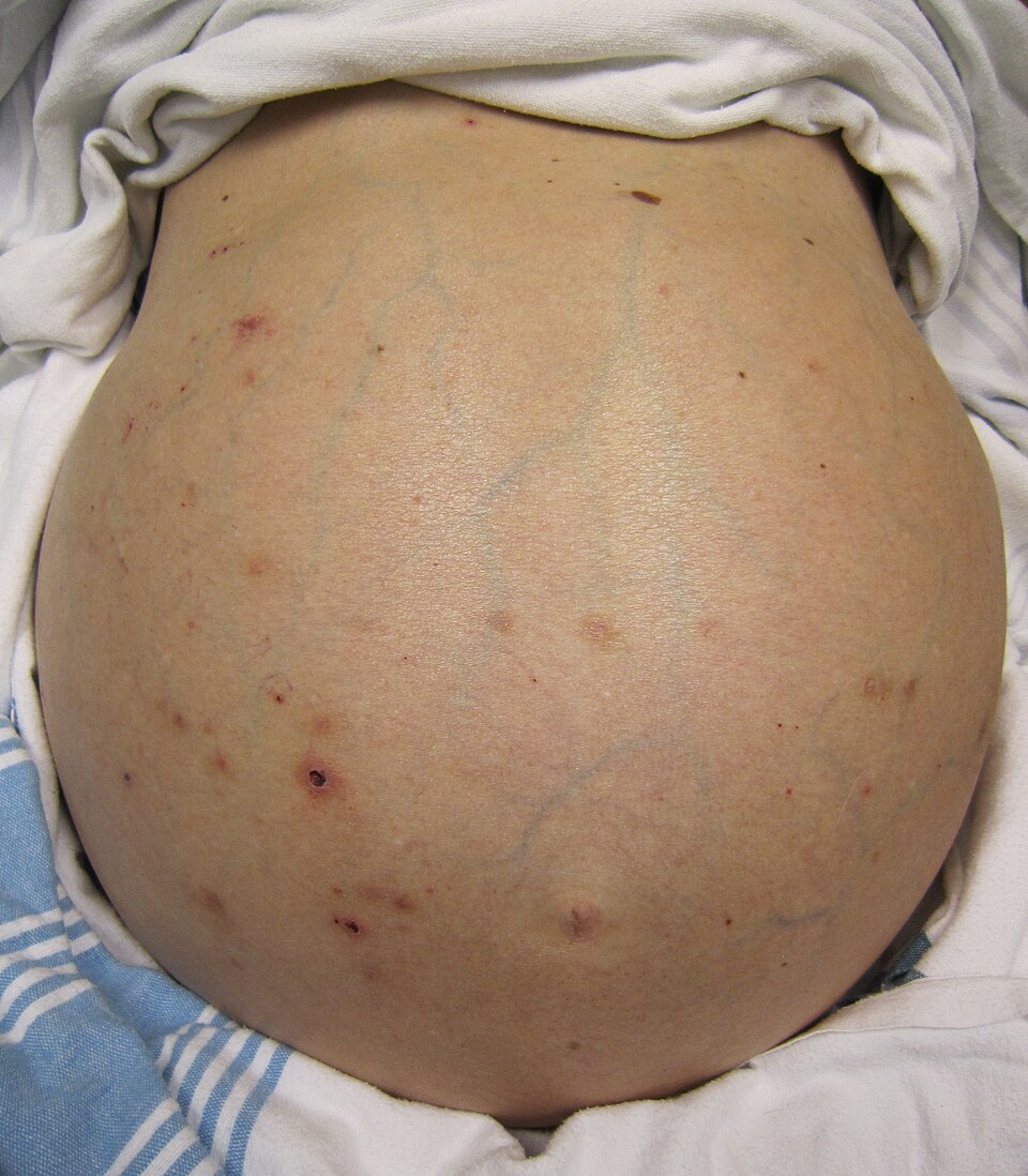 Fayl:Hepaticfailure.jpg