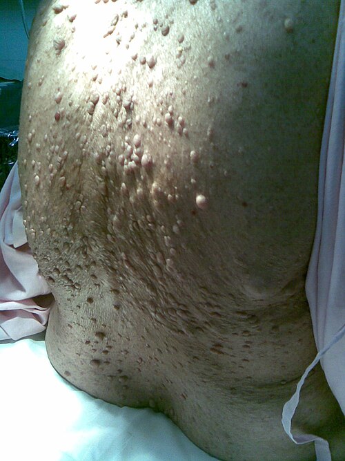 Fayl:Neurofibromatosis.jpg