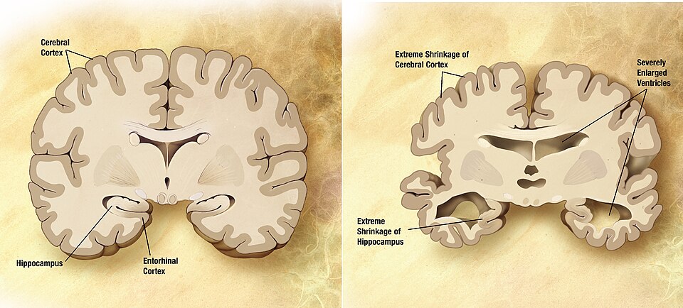 Fayl:Alzheimer's disease brain comparison.jpg