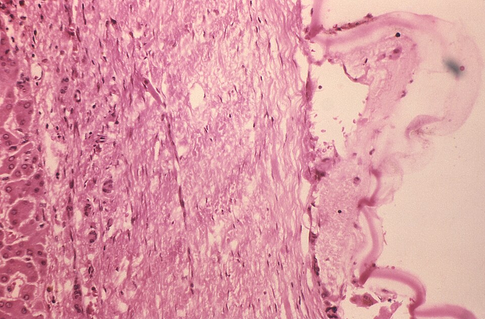 Fayl:Echinococcus vogeli3.jpg