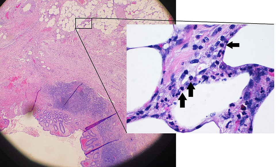 Fayl:Histopathology of periappendicitis.jpg