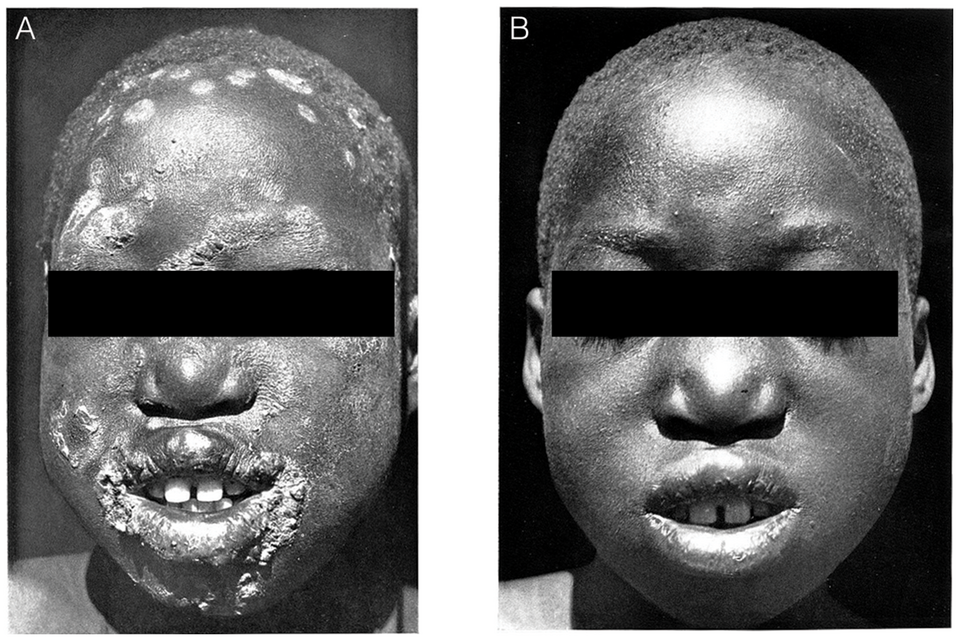Fayl:Yaws treatment.png