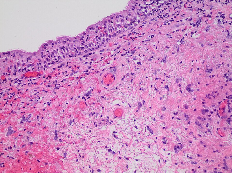 Fayl:Histopathology of radiation cystitis.jpg