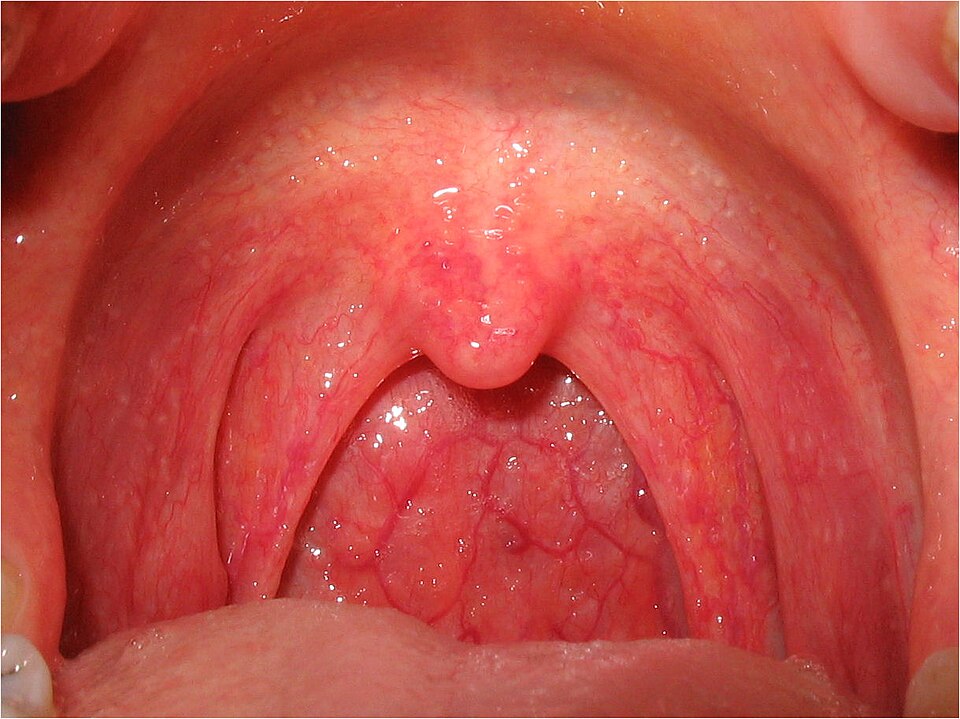 Fayl:Pharyngitis.jpg