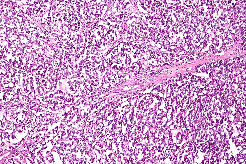 Fayl:Dysgerminoma, intermed. mag.1.jpg