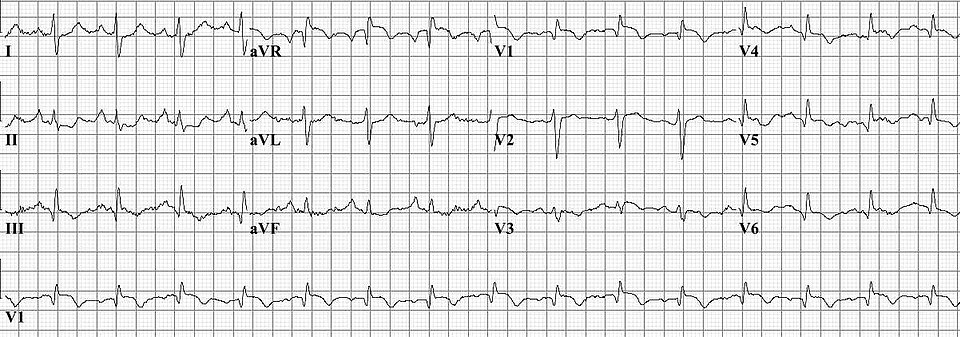 Fayl:Pulm embolism.jpg