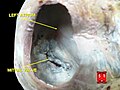Chap bo'lmacha ichidan namunada ko'rilgan mitral qopqoq.