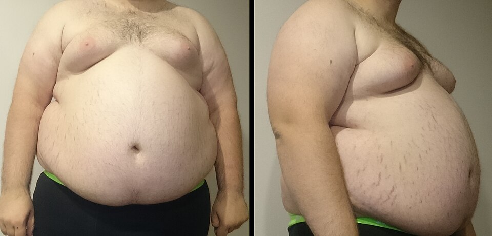 Fayl:Obesity6.JPG