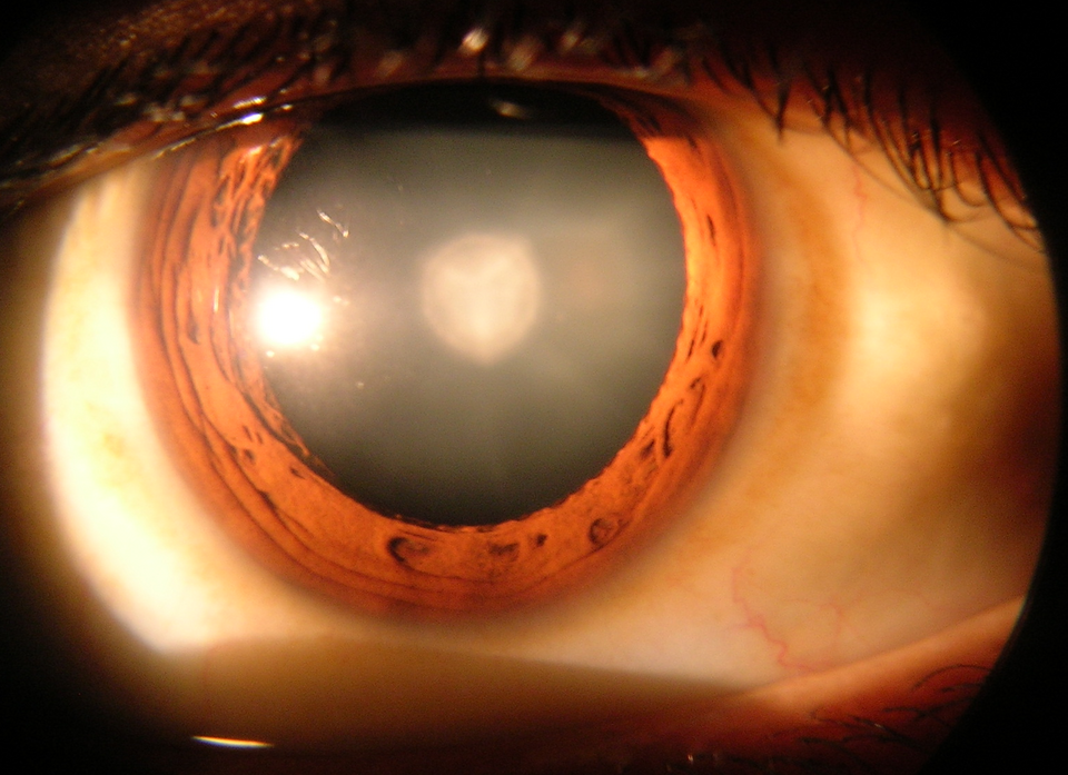 Fayl:Cataract in human eye.png
