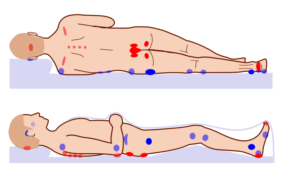 Fayl:Pressure ulcer points.svg
