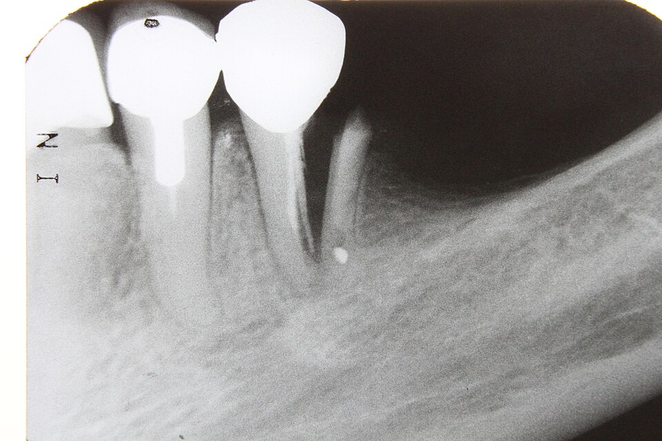 Fayl:Dental x-rays 2010 pd 009.JPG