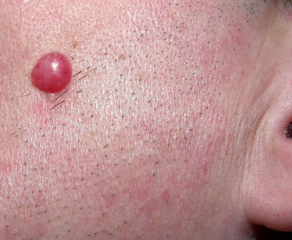 Fayl:Borrelial lymphocytoma.jpg