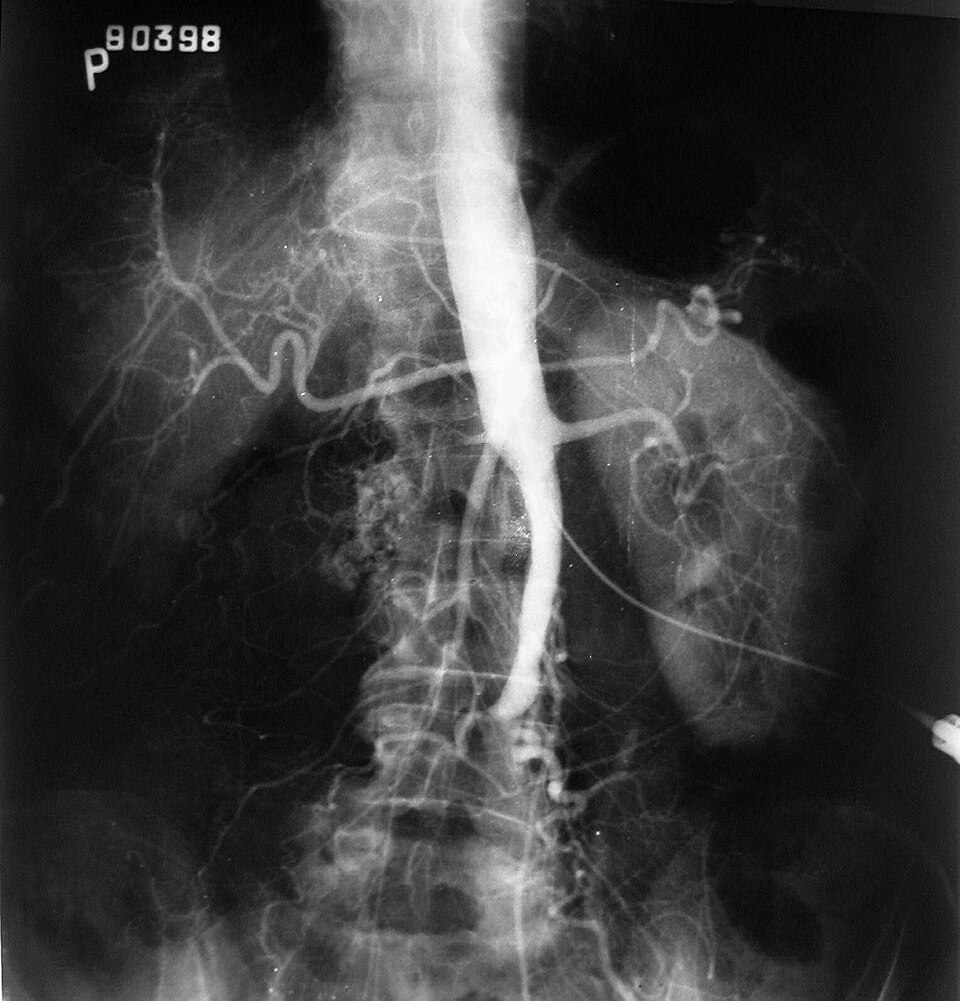 Fayl:Leriche's syndrome.jpg