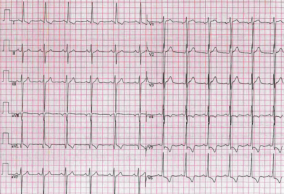 Fayl:Left Ventricular Hypertrophy Unlabeled.jpg