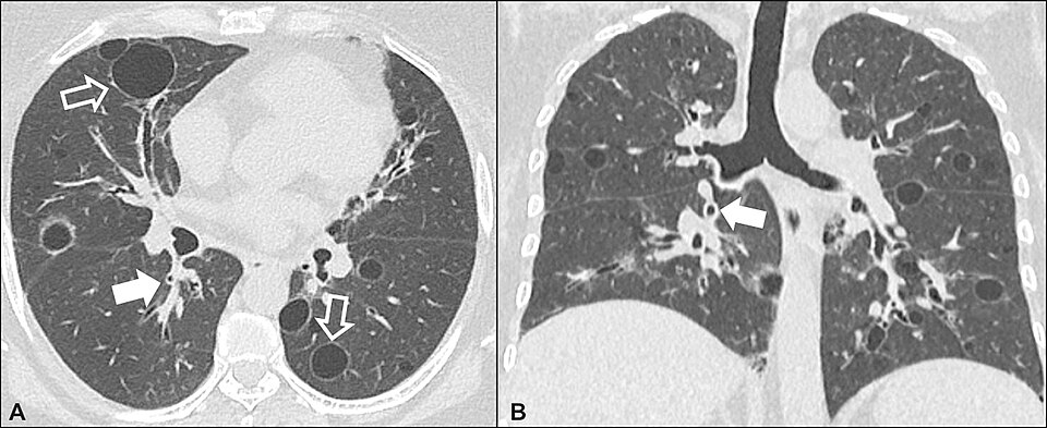 Fayl:CT of lymphocytic interstitial pneumonia.jpg