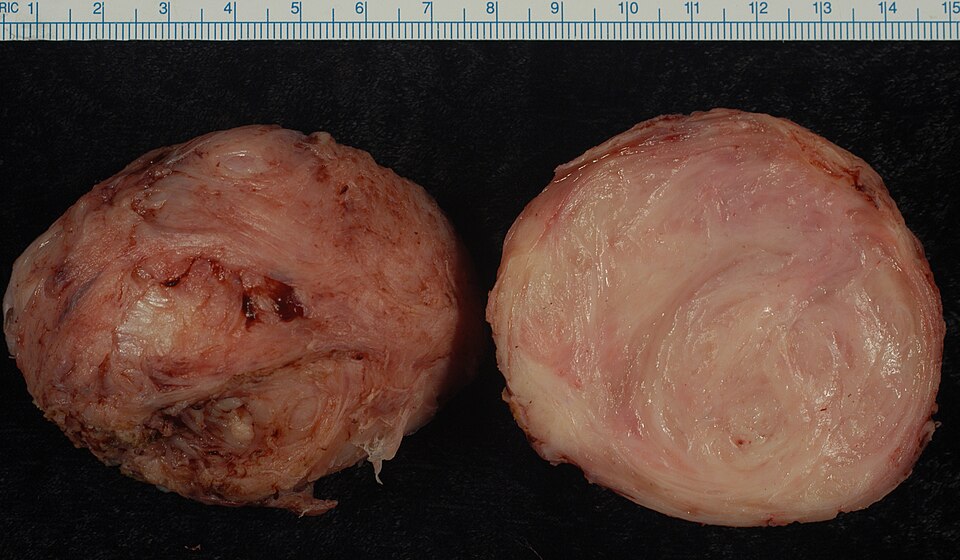 Fayl:Leiomyoma.jpg