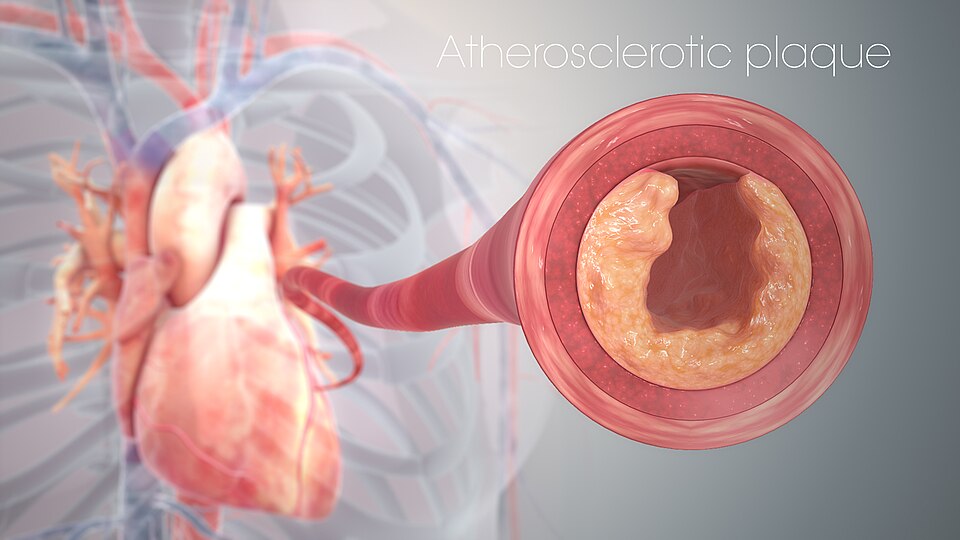 Fayl:Clogged Heart Artery.jpg