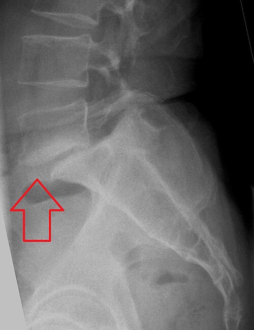 Fayl:SpondylolisthesisL5S1.jpg
