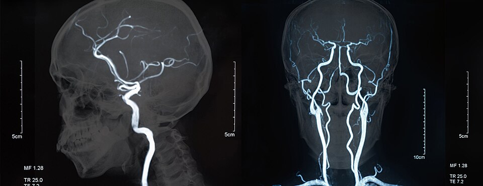 Fayl:Magnetic Resonance Angiography.jpg