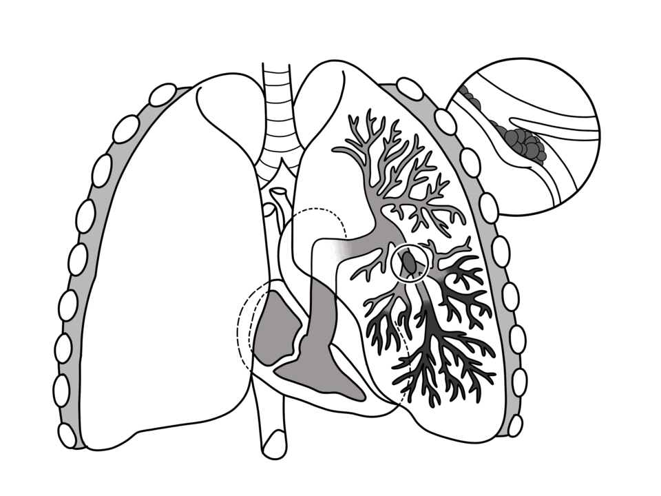 Fayl:Pulmonary-embolism.png