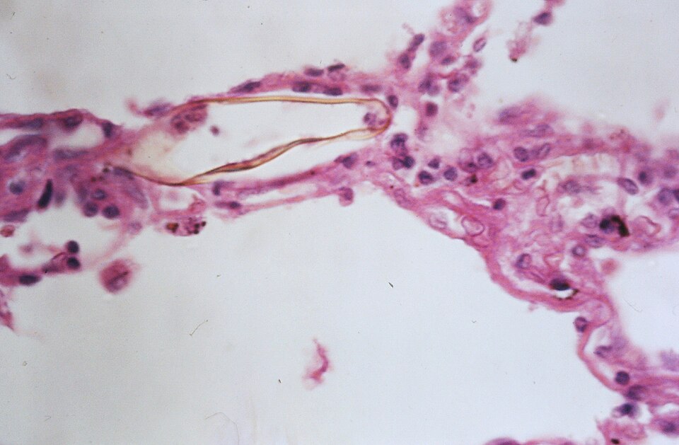 Fayl:Schistosomiasis (13382771945).jpg