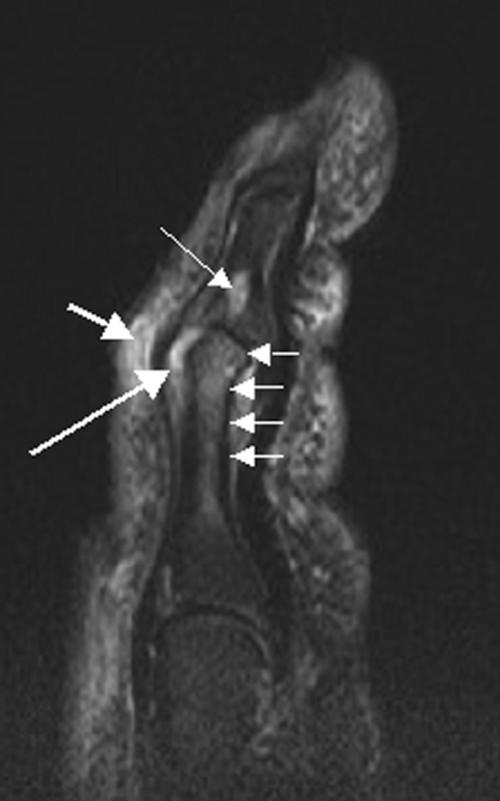 Fayl:Psoriatic arthritis digit ar1934-2.gif