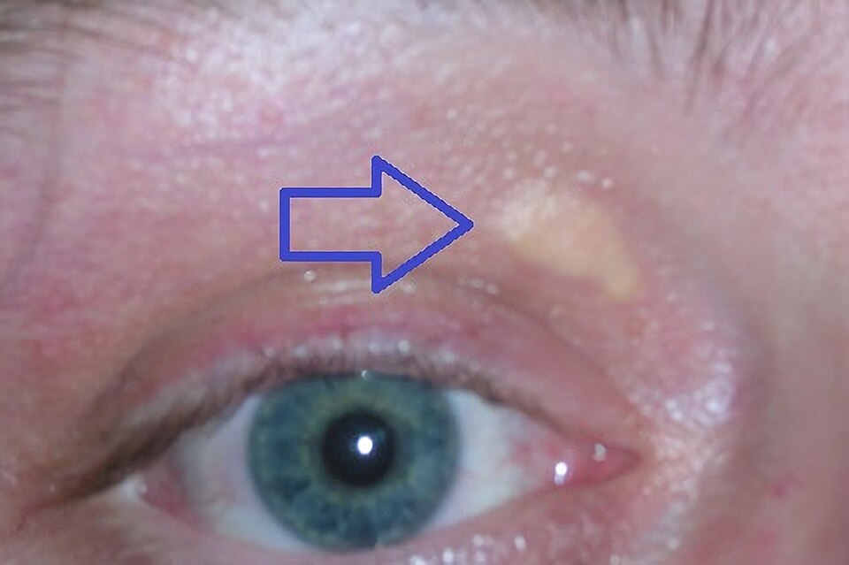 Fayl:Xanthelasma palpebrarum.jpg