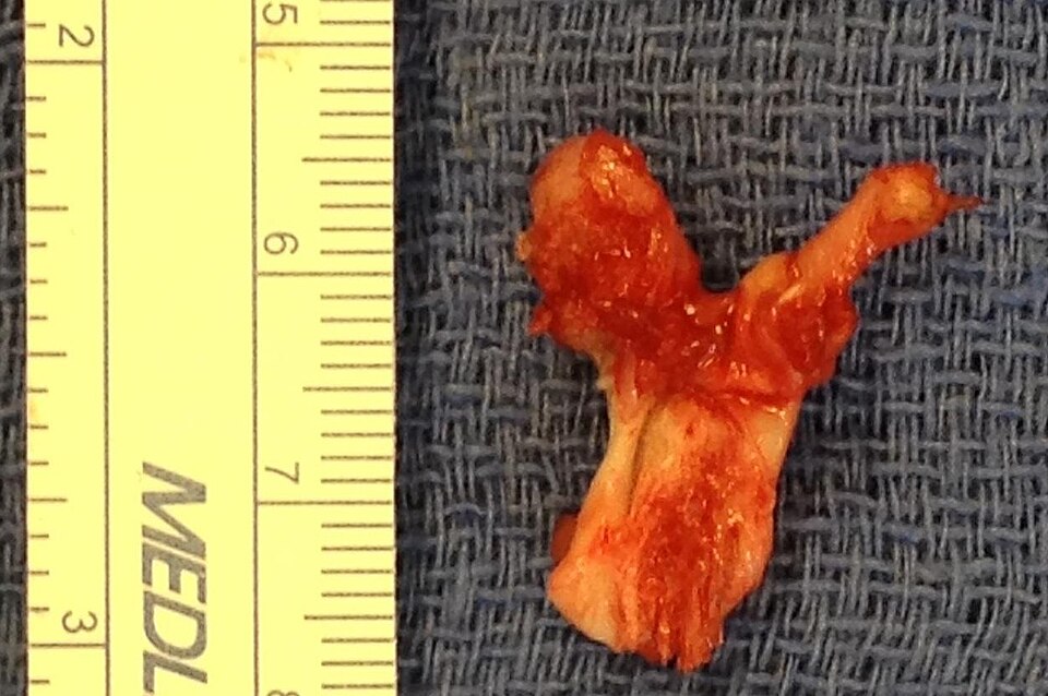 Fayl:Surgically-extracted Tibial Osteochondroma Bone Spur.jpg