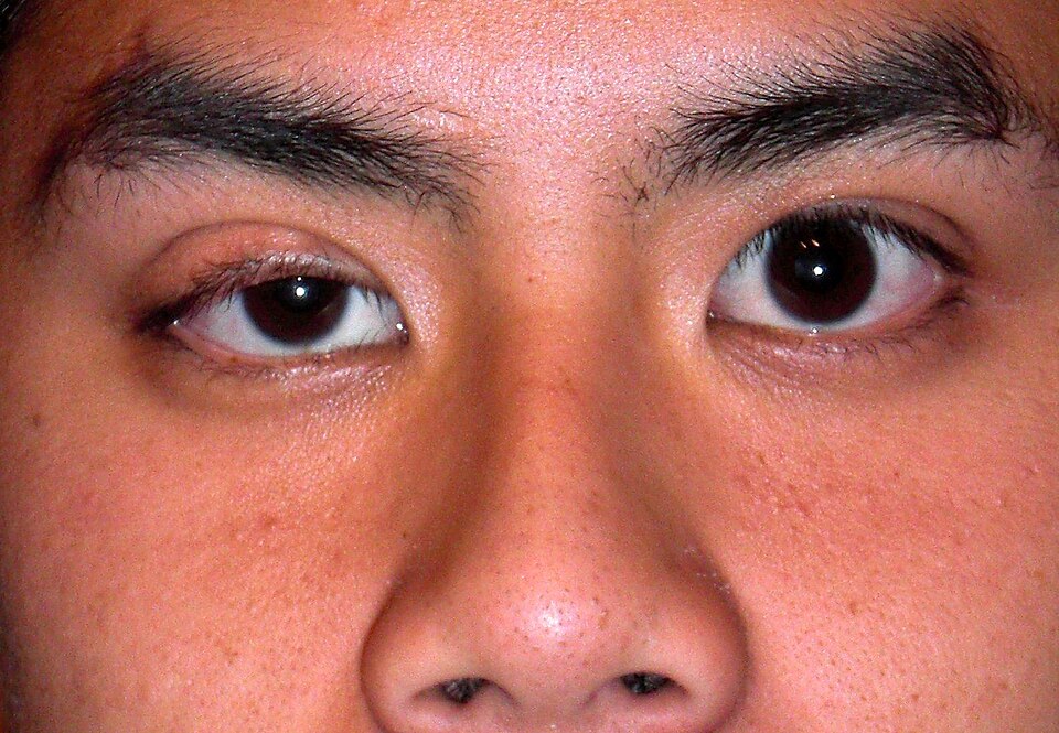 Fayl:Congenitalptosis.JPG