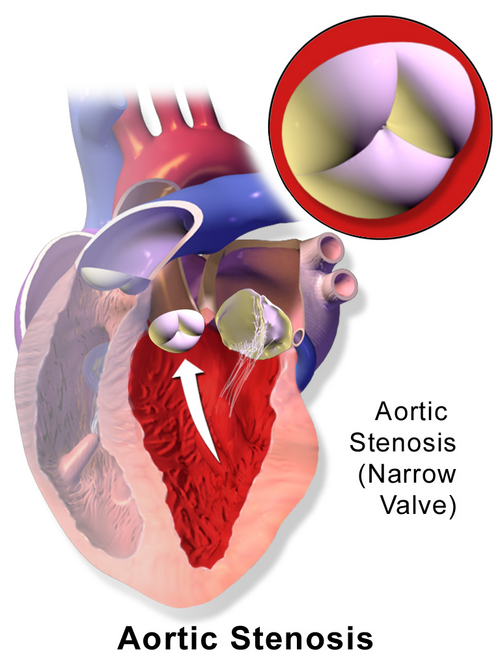 Fayl:Blausen 0040 AorticStenosis.png