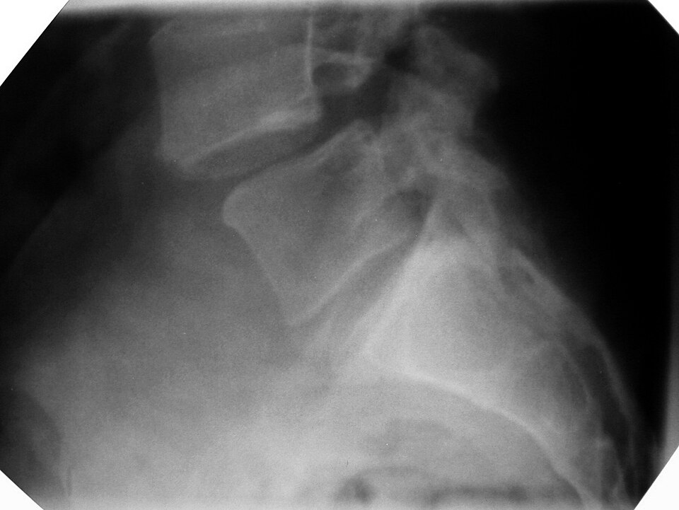 Fayl:Spondylolisthesis.jpg