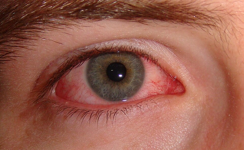 Fayl:Pink eye.jpg
