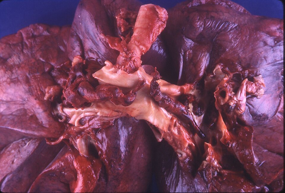 Fayl:Gross Pathology Saddle Pulmonary Embolism.jpg