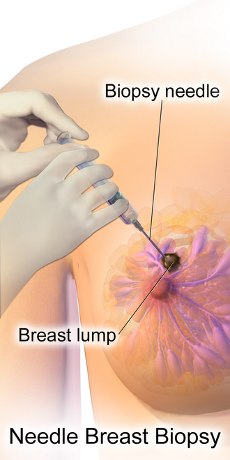 Fayl:Needle Breast Biopsy.png