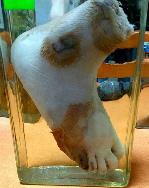 Fayl:Wet gangrene of the foot.jpg
