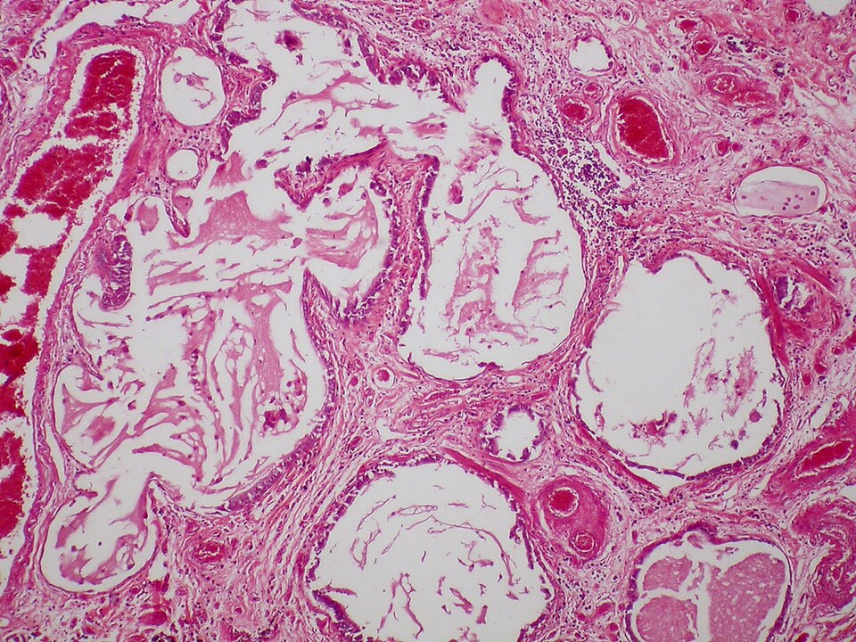 Fayl:Scleroderma - Honeycomb fibrosis.jpg